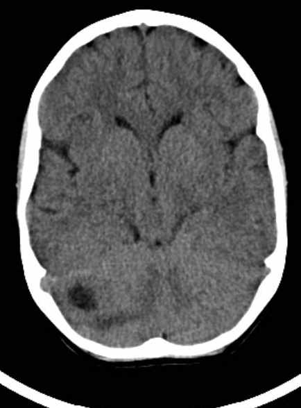 File:Cerebellar abscess (Radiopaedia 73727-84527 Axial non-contrast 34).jpg