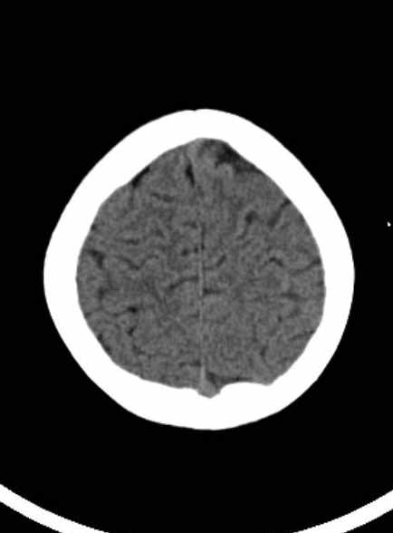 Cerebellar abscess (Radiopaedia 73727-84527 Axial non-contrast 56).jpg