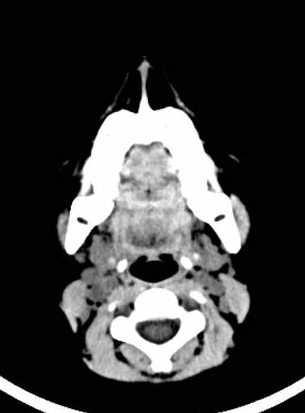 Cerebellar abscess (Radiopaedia 73727-84527 Axial non-contrast 7).jpg