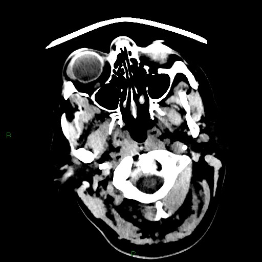 Cerebellar abscess (Radiopaedia 78135-90671 Axial non-contrast 1).jpg