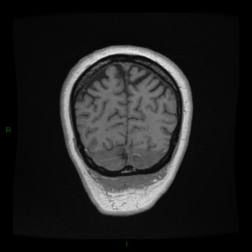 Cerebellar abscess (Radiopaedia 78135-90678 Coronal T1 C+ 144).jpg
