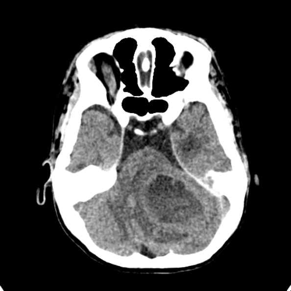 Cerebellar abscess secondary to mastoiditis (Radiopaedia 26284-26412 Axial non-contrast 44).jpg