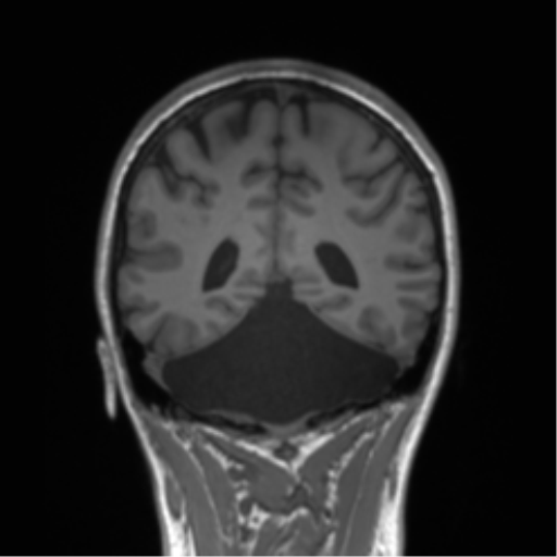 Cerebellar agenesis with hypoplastic pons (pontocerebellar hypoplasia) (Radiopaedia 57224-64138 Coronal T1 32).png
