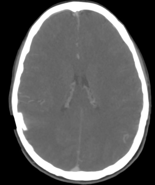 Cerebellar arteriovenous malformation- with hemorrhage (Radiopaedia 35752-37297 B 32).png