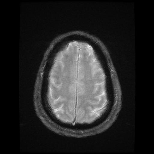 File:Cerebellar hemangioblastoma (Radiopaedia 88055-104622 Axial Gradient Echo 17).jpg