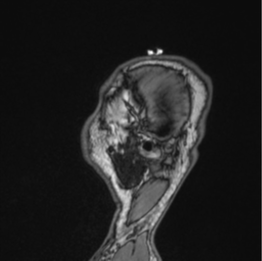 Cerebellar hemangioblastomas and pituitary adenoma (Radiopaedia 85490-101176 Sagittal T1 20).png