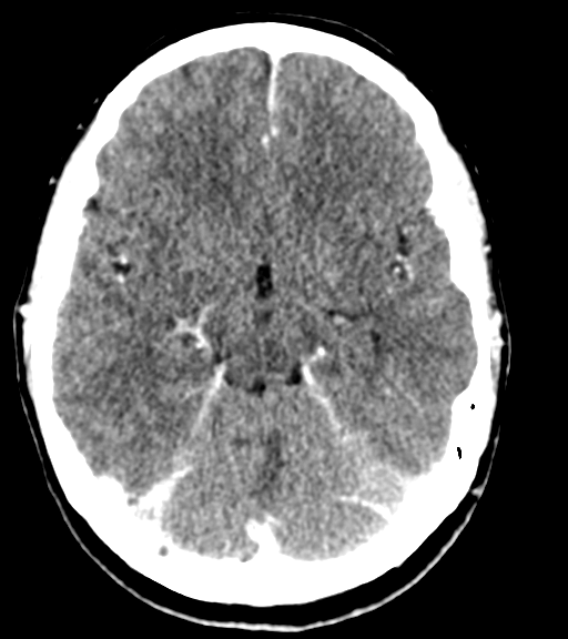 Cerebellar metastases - colorectal adenocarcinoma (Radiopaedia 40947-43652 Axial C+ 22).png