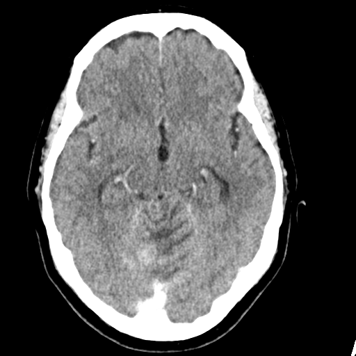 File:Cerebellar metastasis (Radiopaedia 54578-60812 Axial C+ 20).png