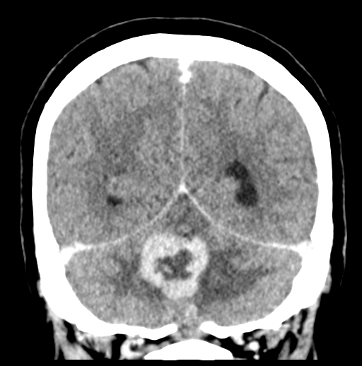 Cerebellar metastasis (Radiopaedia 54578-60812 Coronal C+ 45).png