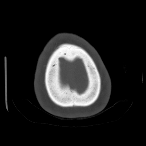 Cerebellar metastasis (cystic appearance) (Radiopaedia 41395-44258 Axial bone window 68).png