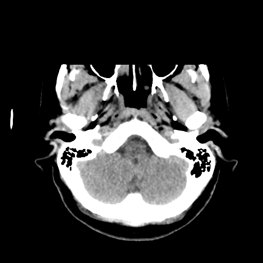 Cerebellar metastasis (cystic appearance) (Radiopaedia 41395-44258 Axial non-contrast 10).png