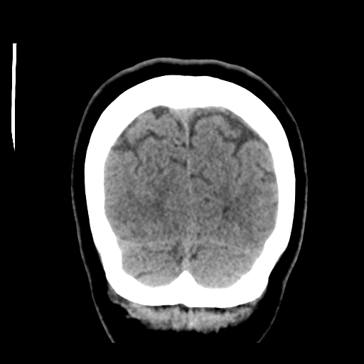 Cerebellar metastasis (cystic appearance) (Radiopaedia 41395-44258 Coronal non-contrast 53).png