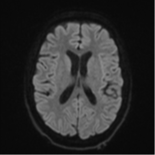 Cerebellar metastasis - adenocarcinoma lung (Radiopaedia 63184-71715 Axial DWI 46).png