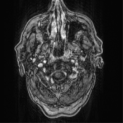 File:Cerebellar metastasis from lung adenocarcinoma (Radiopaedia 86690-102829 Axial T1 C+ 4).png
