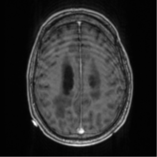 File:Cerebellar metastasis from lung adenocarcinoma (Radiopaedia 86690-102829 Axial T1 C+ 57).png