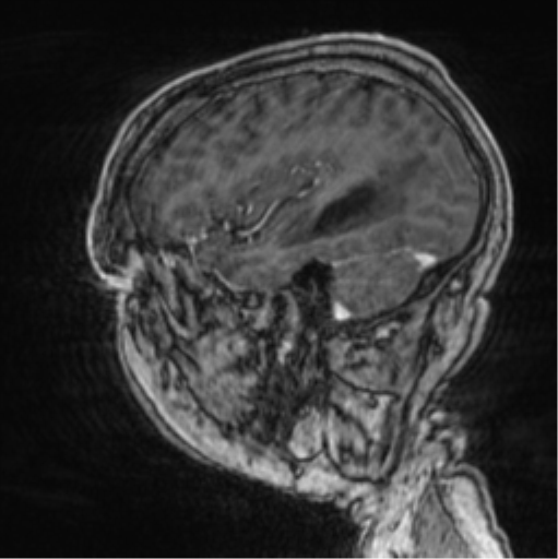 Cerebellar metastasis from lung adenocarcinoma (Radiopaedia 86690-102829 Sagittal T1 C+ 20).png