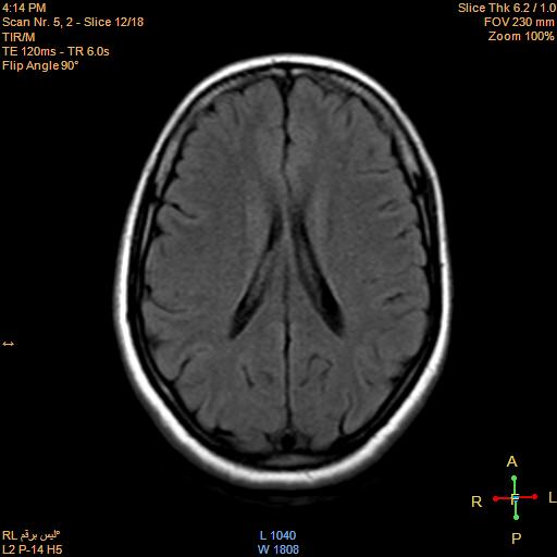 File:Cerebellopontine angle meningioma (Radiopaedia 22488-22525 Axial FLAIR 11).jpg