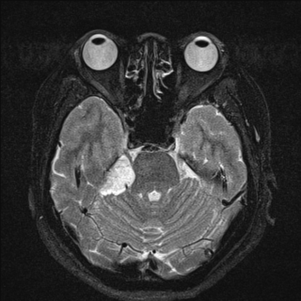 File:Cerebellopontine angle meningioma (Radiopaedia 53561-59591 Axial T2 fat sat 15).jpg