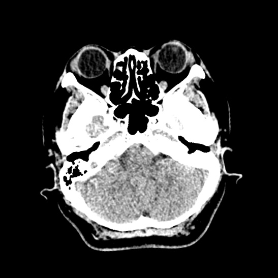 Cerebellopontine angle meningioma (Radiopaedia 53561-59592 Axial non-contrast 14).jpg