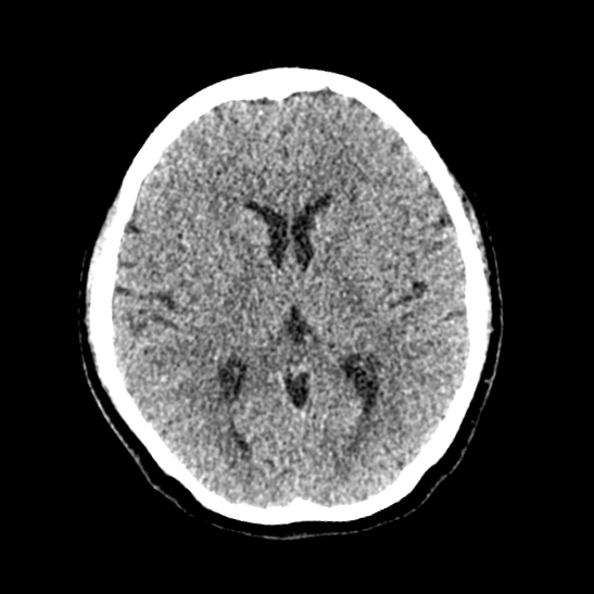 Cerebellopontine angle meningioma (Radiopaedia 53561-59592 Axial non-contrast 36).jpg
