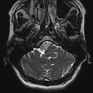 Cerebellopontine angle meningioma (Radiopaedia 72983-83680 Axial FIESTA 10).jpg