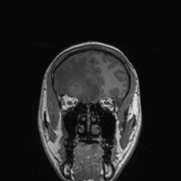 Cerebral abscess (Radiopaedia 24212-24478 Coronal T1 62).jpg