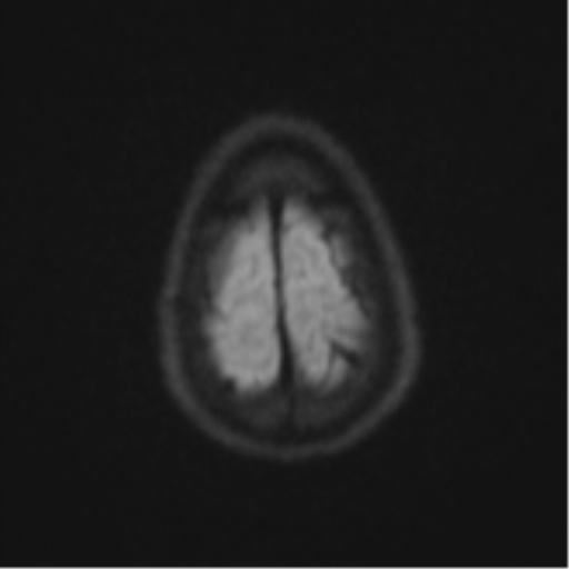 File:Cerebral abscess (Radiopaedia 60342-68009 Axial DWI 69).png