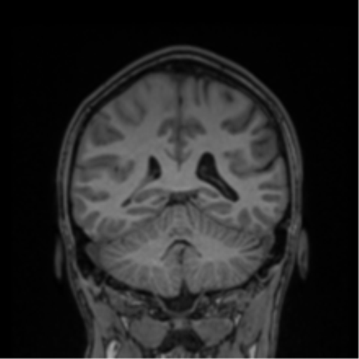 Cerebral abscess (Radiopaedia 60342-68009 Coronal T1 15).png