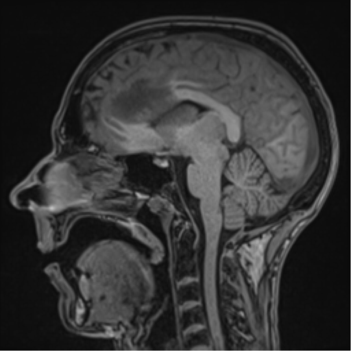 Cerebral abscess (Radiopaedia 60342-68009 Sagittal T1 30).png