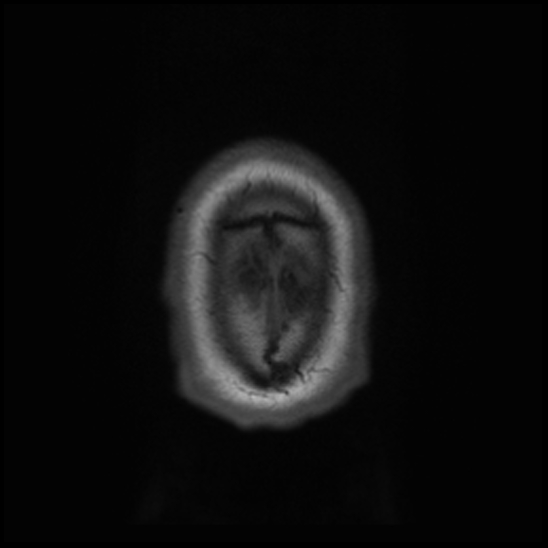 File:Cerebral abscess with ventriculitis (Radiopaedia 78965-91878 Axial T1 48).jpg