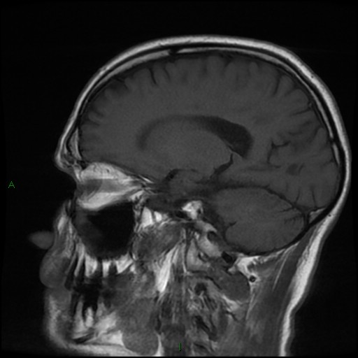 File:Cerebral amyloid angiopathy (Radiopaedia 77506-89664 Coronal T1 11).jpg