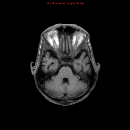 File:Cerebral and orbital tuberculomas (Radiopaedia 13308-13311 Axial T1 7).jpg