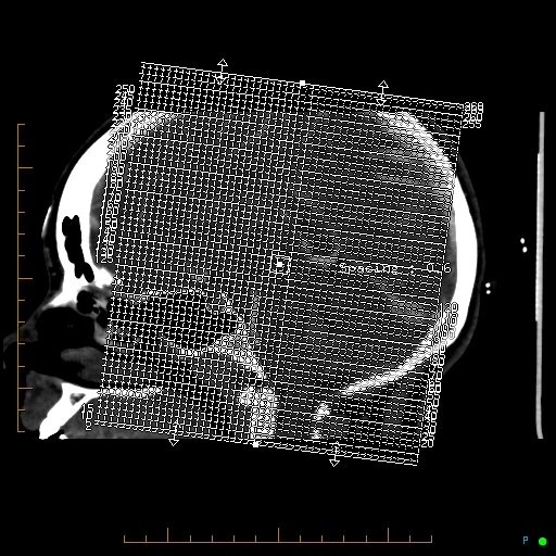 Cerebral arteriovenous malformation (AVM) (Radiopaedia 78162-90706 Axial CTA 1).jpg