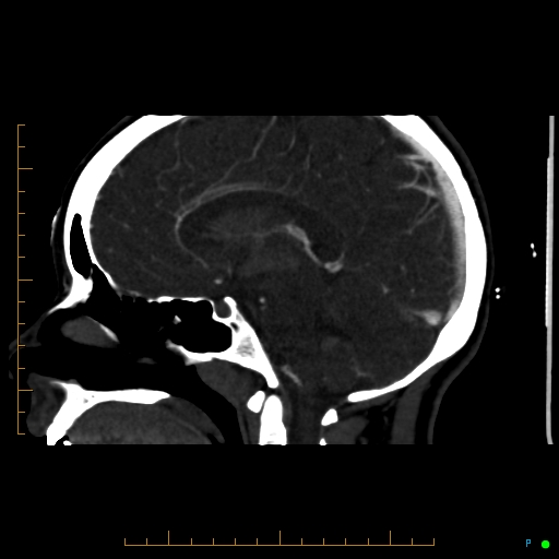 Cerebral arteriovenous malformation (AVM) (Radiopaedia 78162-90706 Sagittal CTA 43).jpg