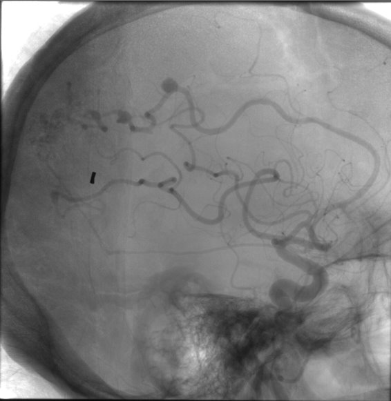 File:Cerebral arteriovenous malformation (Radiopaedia 10989-11408 B 1).jpg