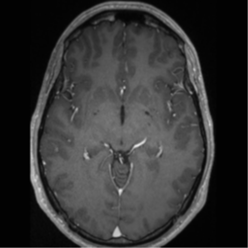 Cerebral arteriovenous malformation (Radiopaedia 55798-62372 Axial T1 C+ 34).png