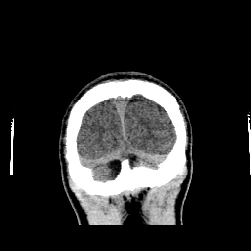 Cerebral arteriovenous malformation (Radiopaedia 61964-70028 Coronal non-contrast 56).jpg