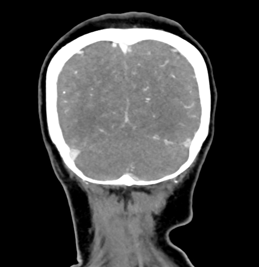 Cerebral arteriovenous malformation (Radiopaedia 73830-84645 C 82).jpg