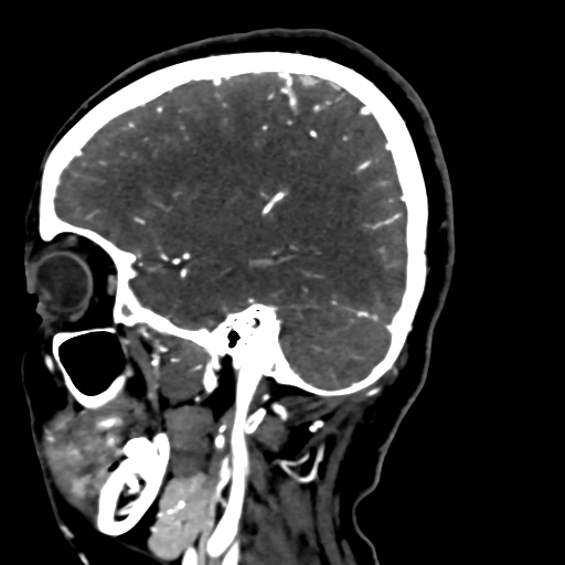 Cerebral arteriovenous malformation (Radiopaedia 73830-84645 Sagittal C+ delayed 67).jpg