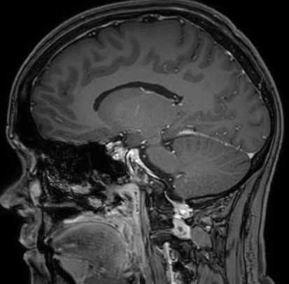 Cerebral arteriovenous malformation (Radiopaedia 74411-85654 Sagittal T1 C+ 55).jpg