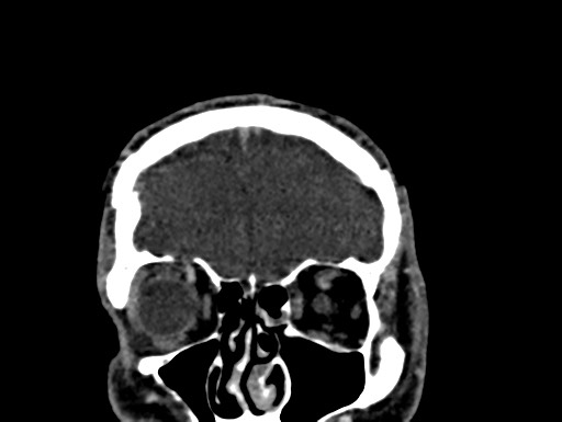 Cerebral arteriovenous malformation (Radiopaedia 78188-90746 Coronal C+ delayed 12).jpg
