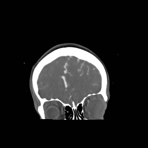File:Cerebral arteriovenous malformation (Radiopaedia 79677-92888 B 4).jpg