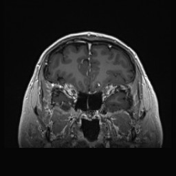 Cerebral arteriovenous malformation (Radiopaedia 84015-99245 Coronal T1 C+ 44).jpg