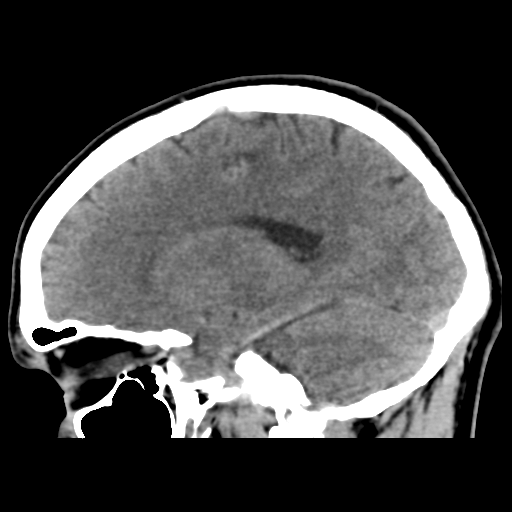 File:Cerebral arteriovenous malformation (Spetzler-Martin grade 2) (Radiopaedia 41262-44076 A 27).png