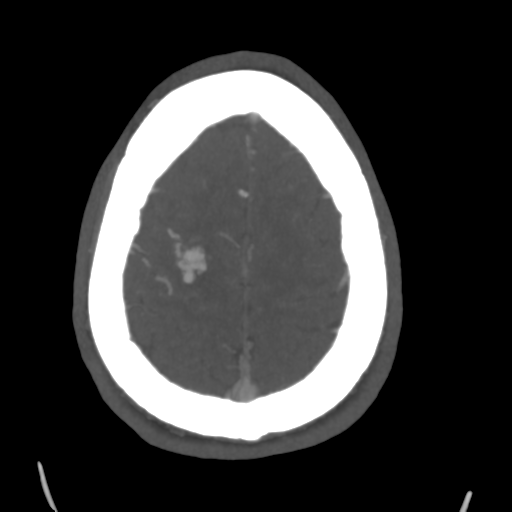 Cerebral arteriovenous malformation (Spetzler-Martin grade 2) (Radiopaedia 41262-44076 E 45).png