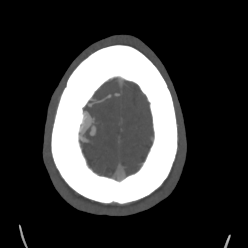 Cerebral arteriovenous malformation (Spetzler-Martin grade 2) (Radiopaedia 41262-44076 E 48).png
