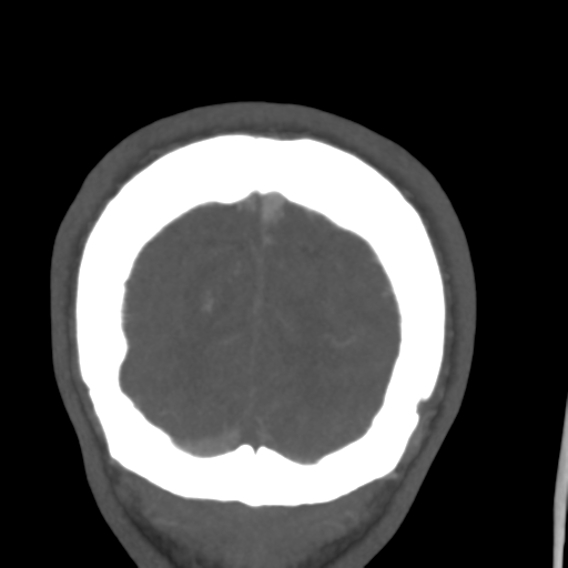Cerebral arteriovenous malformation (Spetzler-Martin grade 2) (Radiopaedia 41262-44076 F 60).png