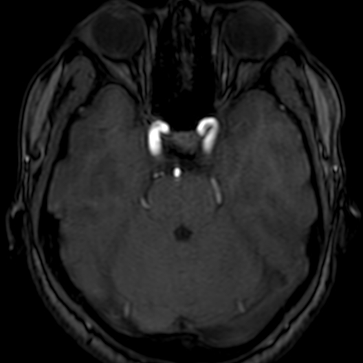 Cerebral arteriovenous malformation at posterior body of corpus callosum (Radiopaedia 74111-84925 Axial MRA 62).jpg