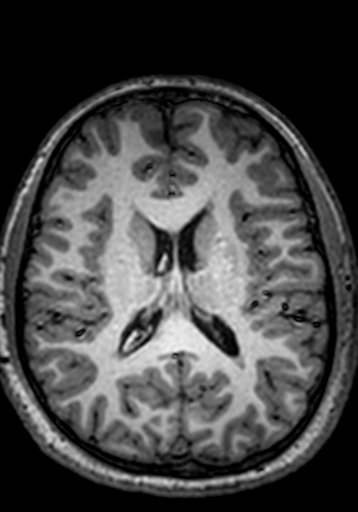Cerebral arteriovenous malformation at posterior body of corpus callosum (Radiopaedia 74111-84925 Axial T1 119).jpg