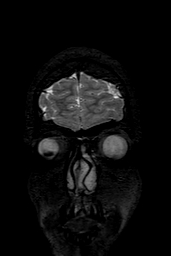 Cerebral arteriovenous malformation at posterior body of corpus callosum (Radiopaedia 74111-84925 Coronal T2 9).jpg